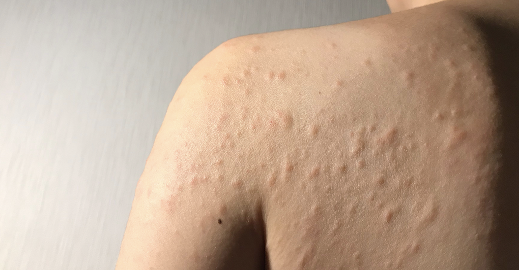 Heat Hives: 6 Ways to Control Cholinergic Urticaria