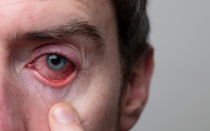 Allergic eye disease